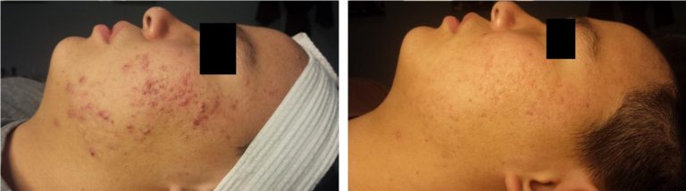 acne-treatment-1-2-1-768x214