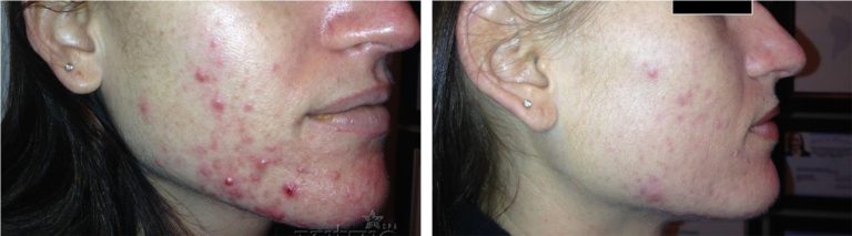 acne-treatment-3-768x213